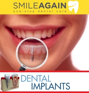 Dental Implants Cost in Mumbai